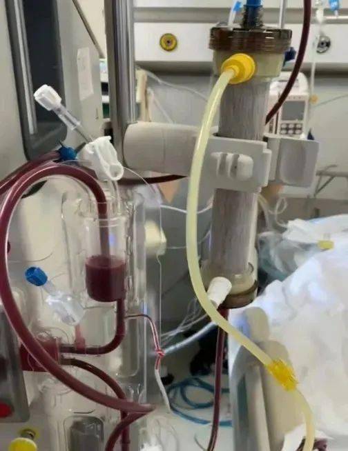 女子|广东一女子吃进ICU，血液变成“奶茶”色！冬天很多人这样干