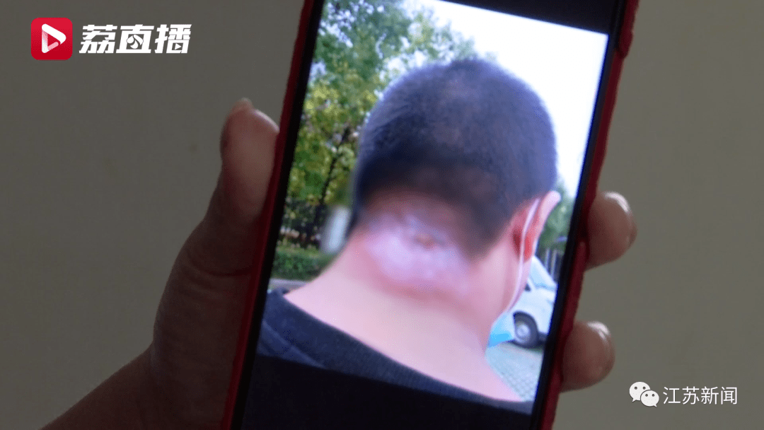 結果|男子隨手擠了顆痘痘，結果長出拳頭大膿包