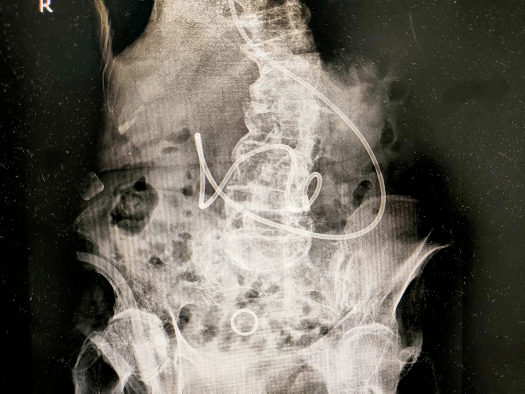 鼻空肠管X线图片