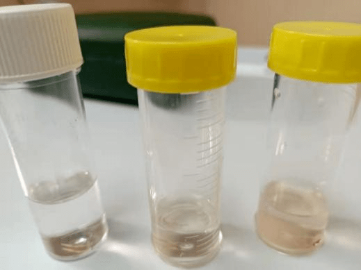 检查|【新闻快递】呼吸重症监护室成功开展两例危重症患者“床旁超声引导下经皮肺穿刺组织活检术”