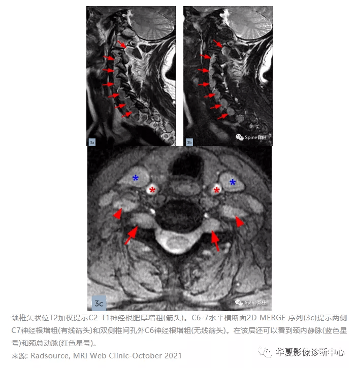 症状|肌肉萎缩、腰疼及神经根肥大原来是这种病！切记