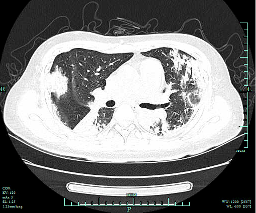 检查|【新闻快递】呼吸重症监护室成功开展两例危重症患者“床旁超声引导下经皮肺穿刺组织活检术”