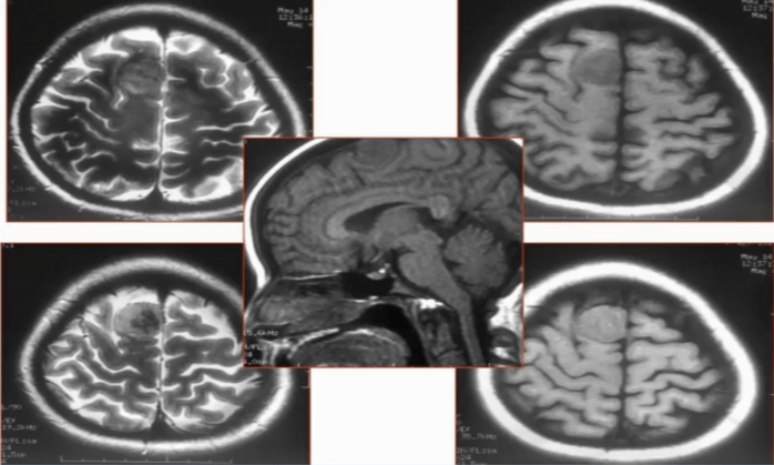 颅脑ct怎么看简明又详细的头部ct读片详解