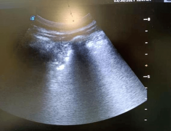 检查|【新闻快递】呼吸重症监护室成功开展两例危重症患者“床旁超声引导下经皮肺穿刺组织活检术”