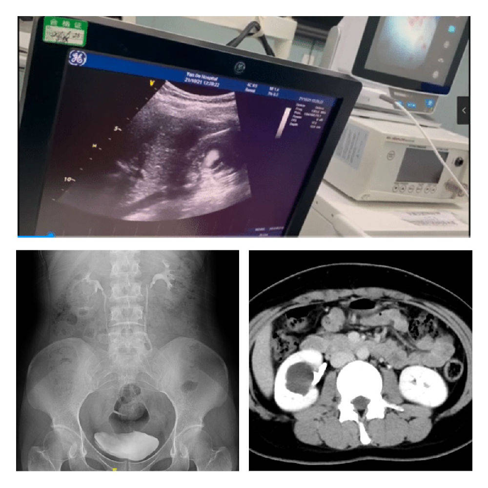 输尿管|做了肾盂旁囊肿手术却没有疤痕,怎么回事?