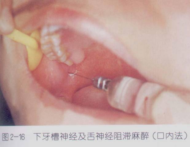 临床上使用的口腔麻醉剂普鲁卡因利多卡因布比卡因丁卡因布比卡因局部