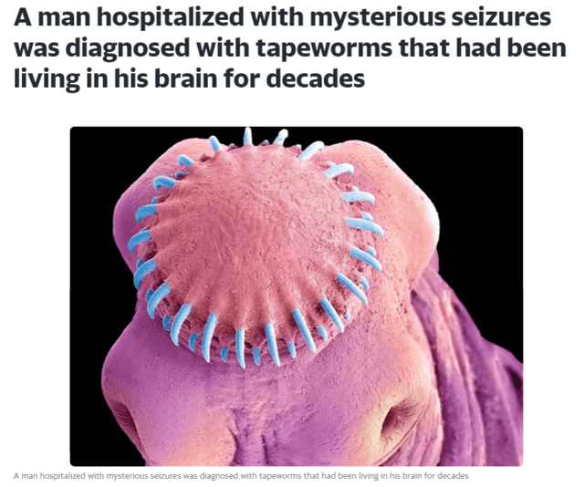 传播|恐怖！一男子因神秘癫痫住院，原来绦虫已在脑中“安家”十几年