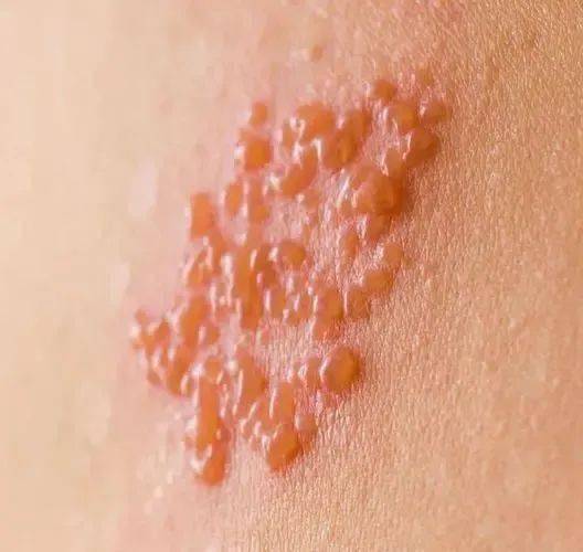 什么是单纯疱疹病毒 5cf873861a2e4a4287240d68476fd4f6.jpeg