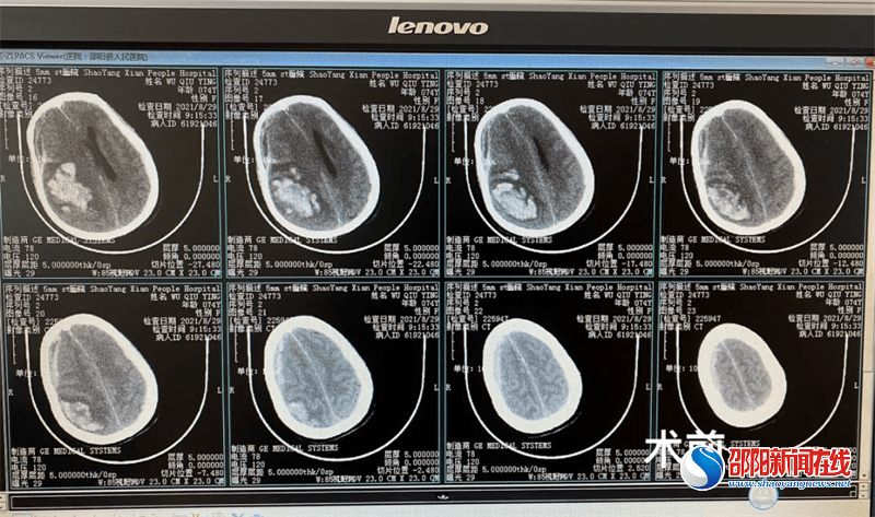 诊断|邵阳县人民医院：初探多学科诊疗模式（MDT），让患者获得精准治疗