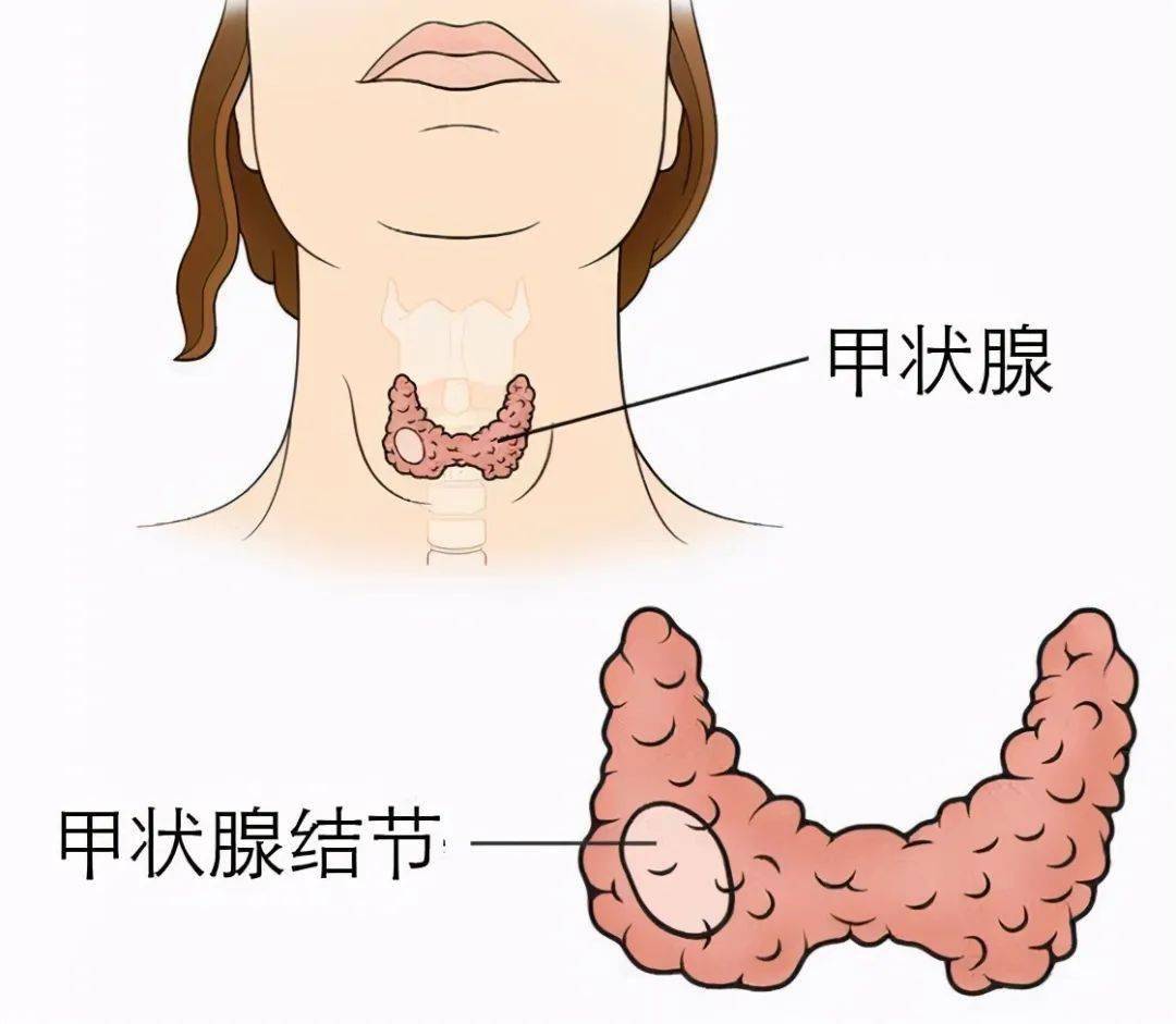 诊断|体检发现甲状腺结节怎么办？南京市第一医院专家“一针”辨“善恶”