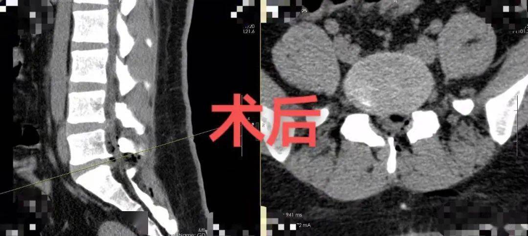 左腿|每天久坐16个小时，21岁小伙腰椎间盘突出