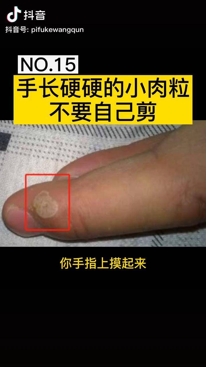 手上长硬硬的小肉粒不要自己剪也不到乱摸身体其它部位疣皮肤