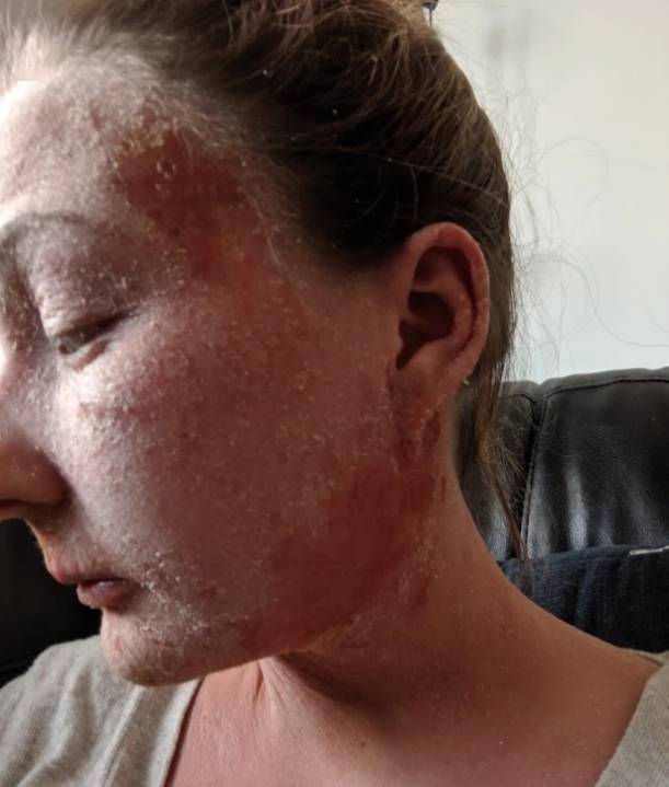 感觉|女子使用类固醇霜治疗湿疹 皮肤脱落渗液