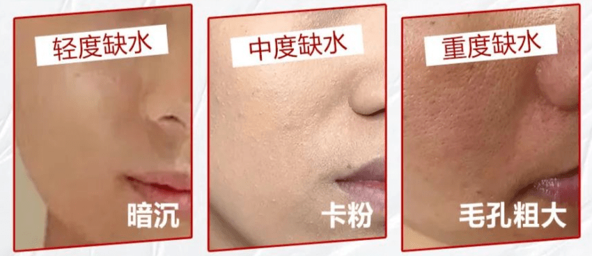 缺水程度自测,你的皮肤有多渴?_丁叔