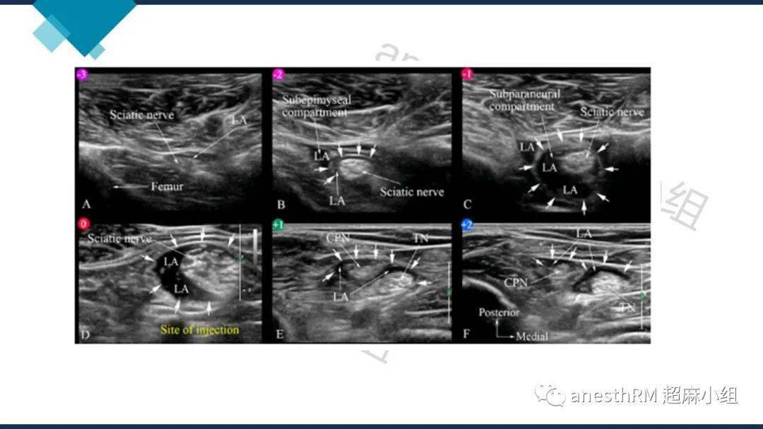 超声引导下腘窝坐骨神经阻滞