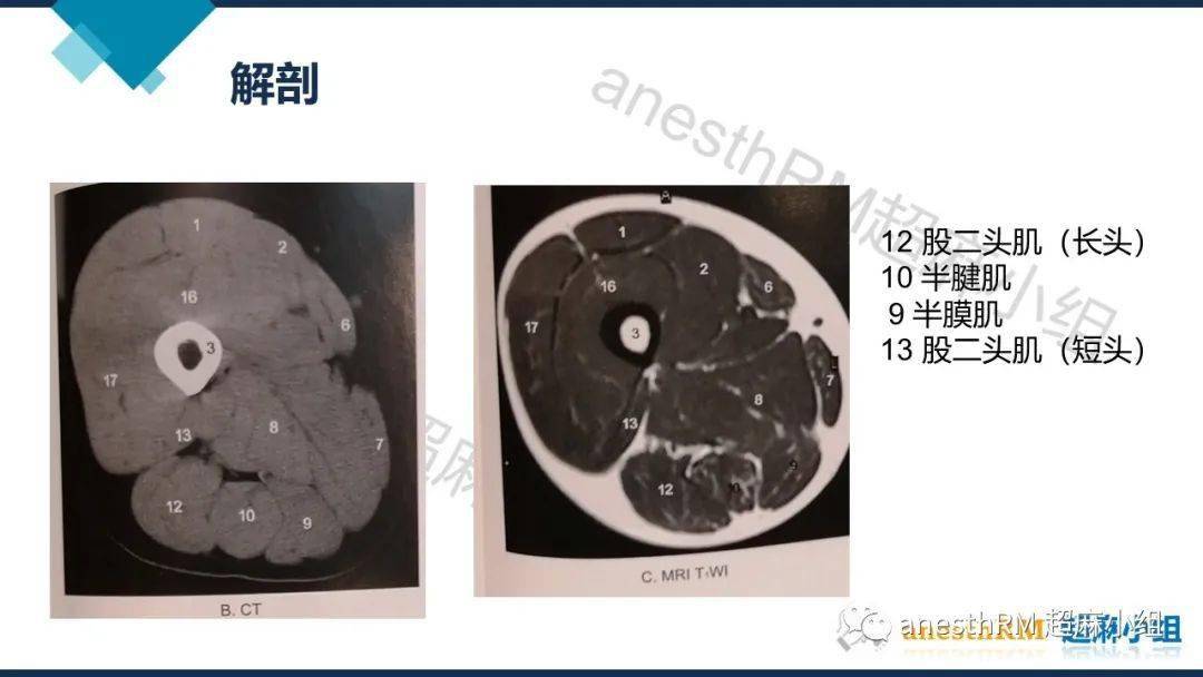 超声引导下腘窝坐骨神经阻滞