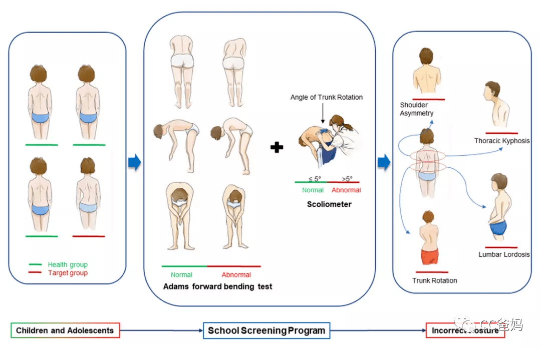 每6個孩子就有一個脊柱側彎只因10歲前家長忽略了這一點