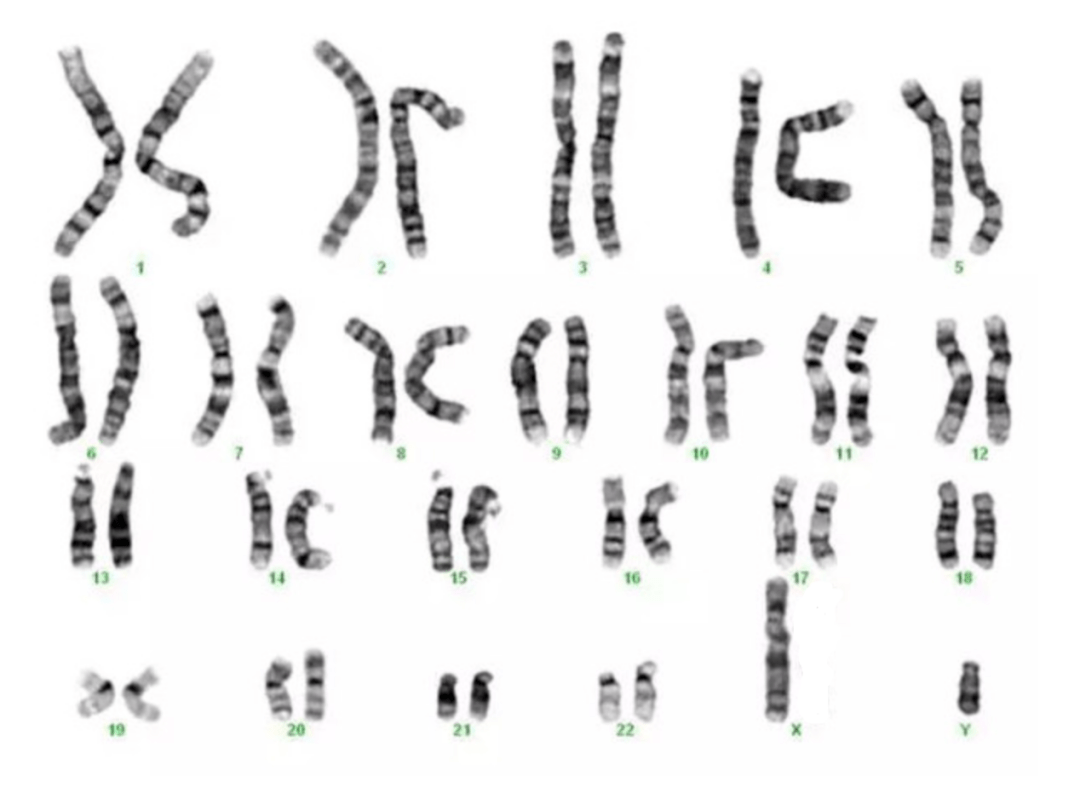正常染色体报告单图片图片