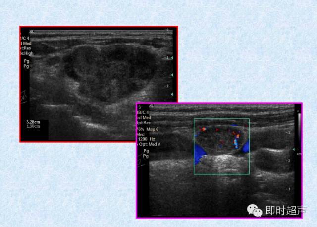 史上最實用甲狀腺超聲診斷有圖有真相