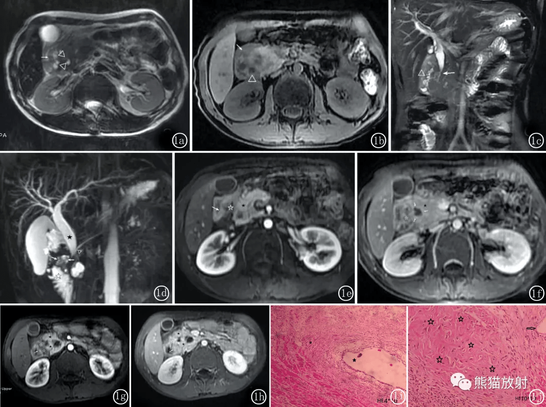 实质|沟槽区胰腺炎丨临床及影像表现