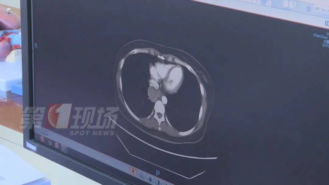 肿瘤|女子手指肿成“萝卜头”，一查竟是癌症！出现这些信号请务必警惕