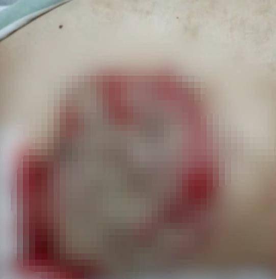 余先生|广东一男子乳下皮肤溃破，一查是乳腺癌？这个症状要注意