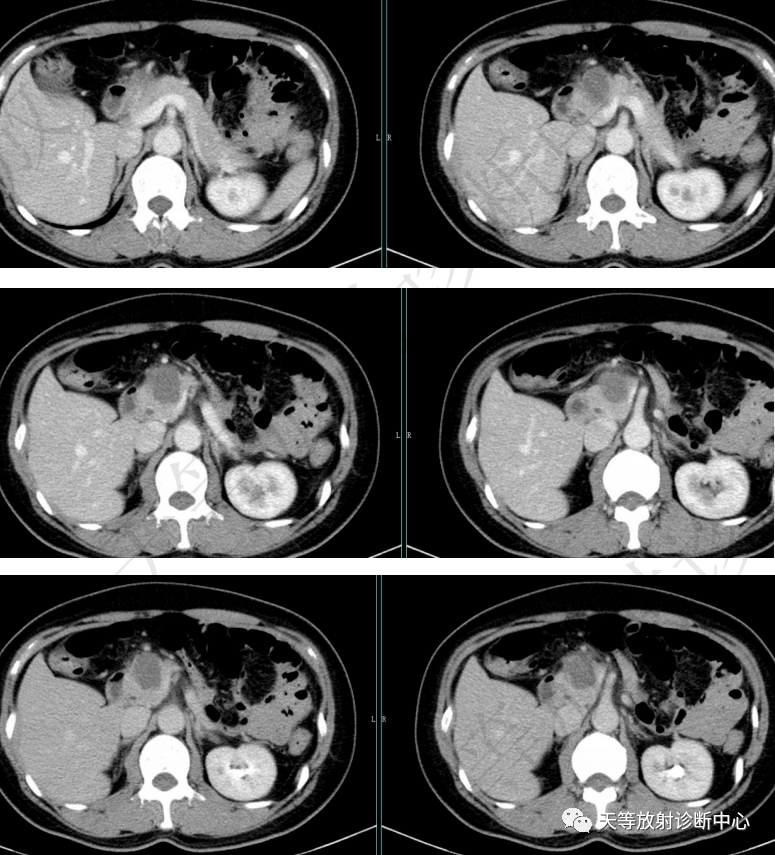 罕见病胰腺腺泡细胞癌