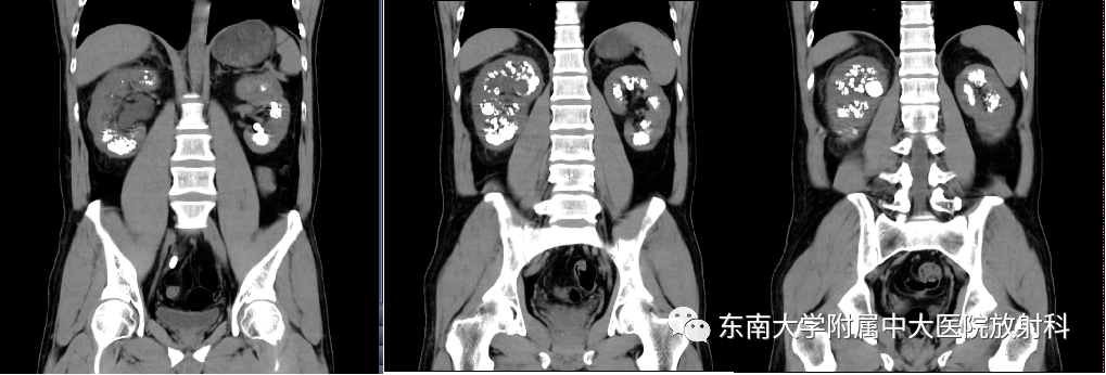 海绵肾影像图片