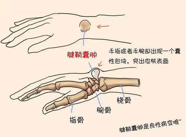 不手術,外洗(針刺)消腱鞘炎/腱鞘囊腫於無形_閆夫人_治療_腫塊