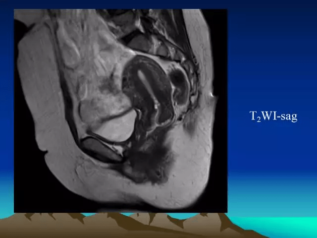 子宫常见疾病的mri诊断