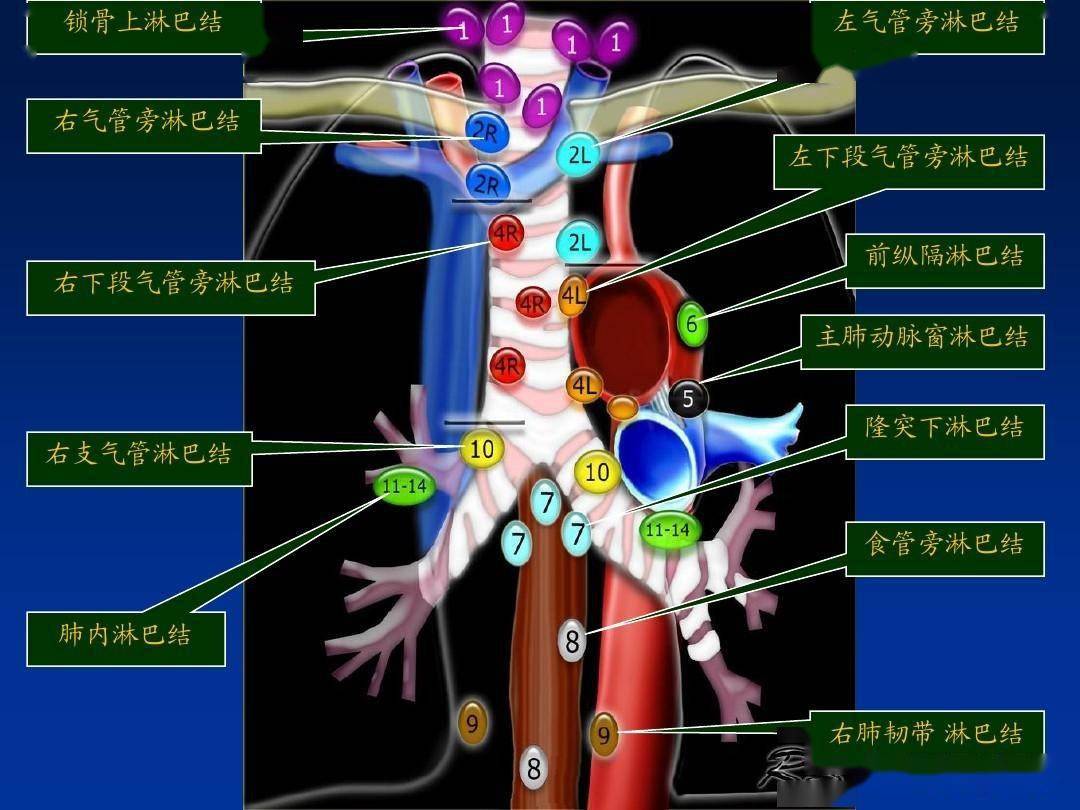 三维适形放疗用于食管癌纵隔淋巴结转移治疗的疗效