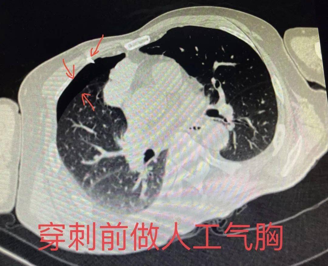 典型病例丨我院成功開展人工氣胸後ct引導下縱隔病變穿刺活檢術