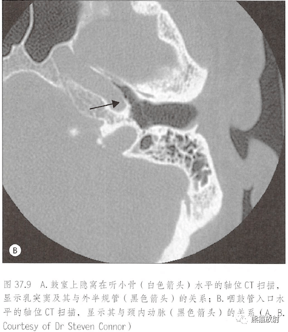 箭頭分別所指:聽小骨,半規管,頸內動脈左側鼓室內側壁前外側面觀聽小