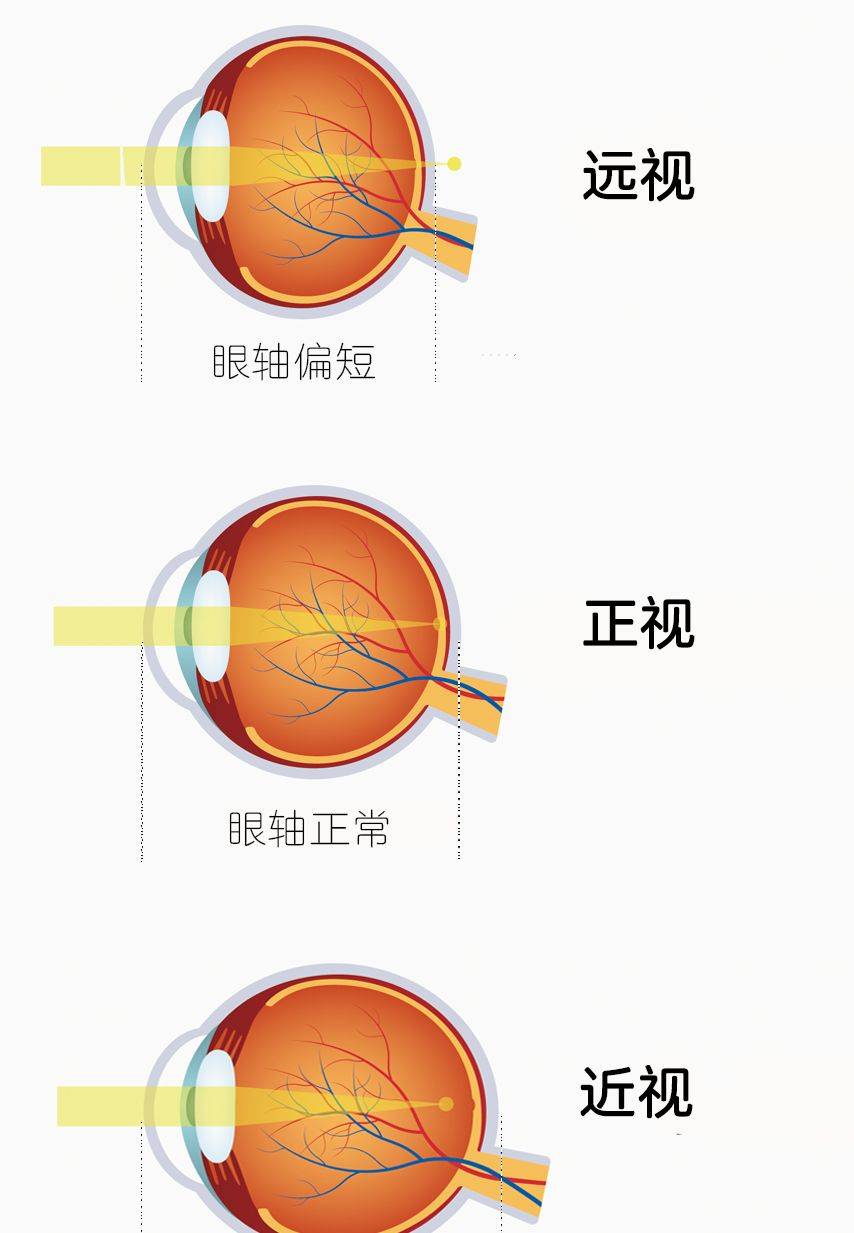图片来源:站酷海洛  远视就是气球还没被吹起,扁扁的(眼轴偏短),光线