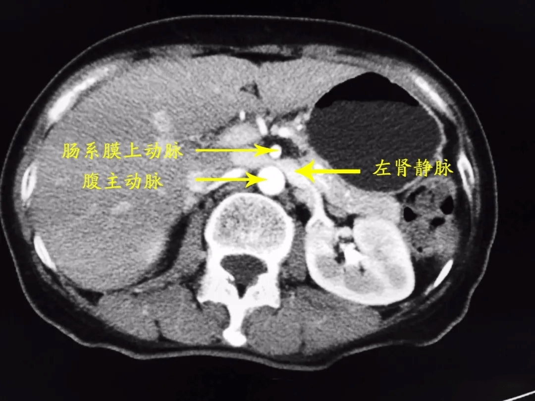 胡桃夹CT图片图片