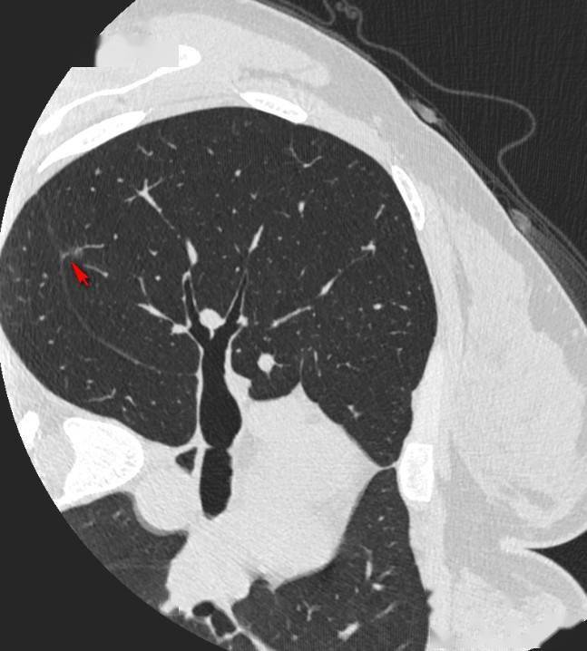 这样的结节可以考虑手术,多种恶性征象集于一身,大家可对照一下