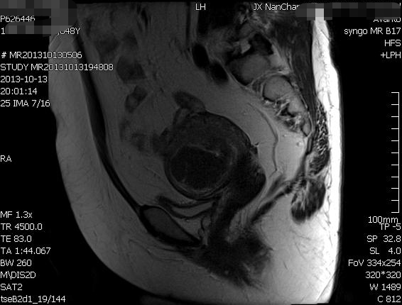 【spark病例挑战第127期】45岁女,超声发现子宫占位?