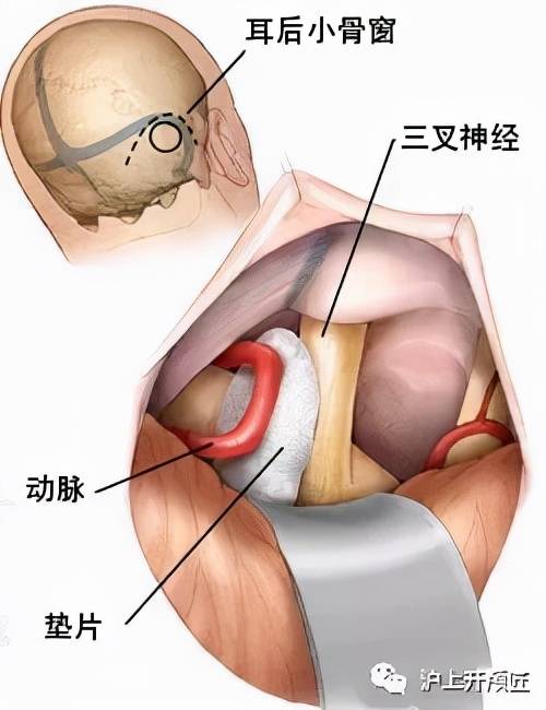 三叉神经痛需要手术吗