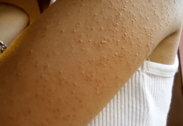 鸡皮肤的四大形成原因,如何消除鸡皮肤光滑肌肤_状况_饮食_时候