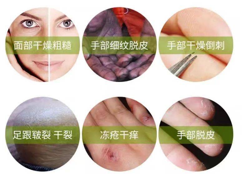 草本植物脚跟开裂、老茧、死皮……又疼又丑！用它一抹，双脚嫩滑，实测惊呆了！