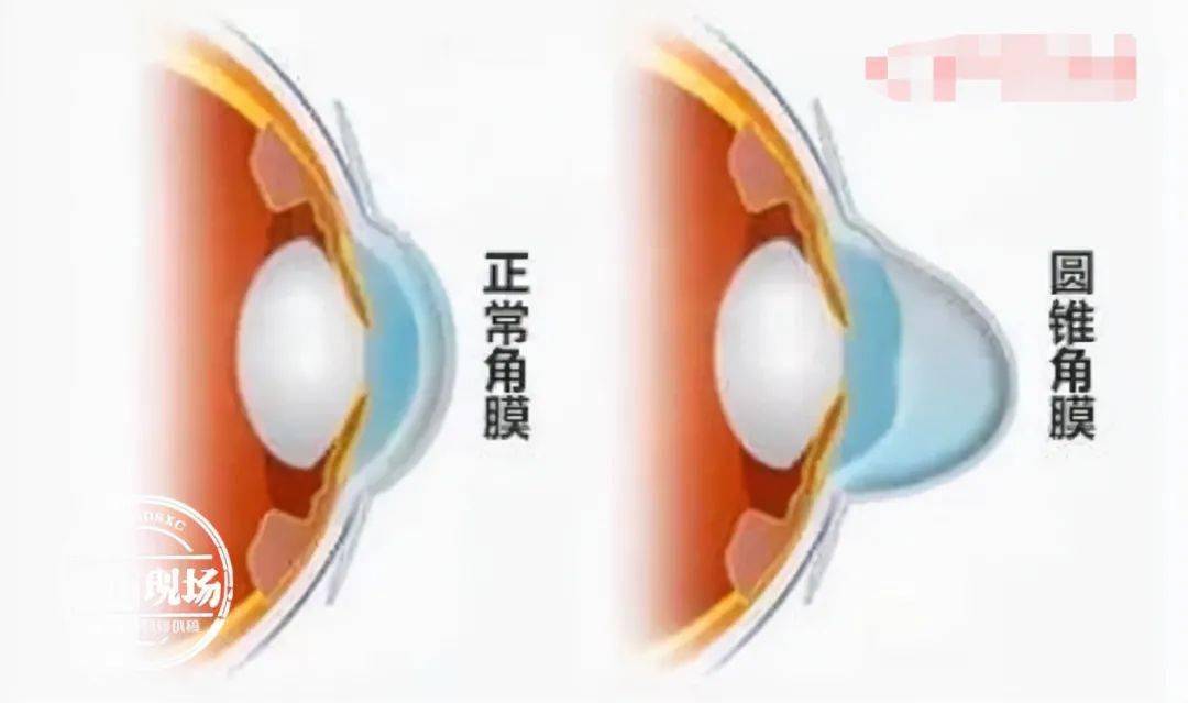 彭凯俊|没事爱揉眼睛，13岁男孩把眼角膜揉破了