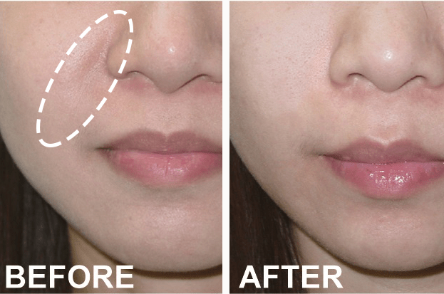 怎样才能不长法令纹 7fc39f9b9b884dc19adaffa7c7655a43.png