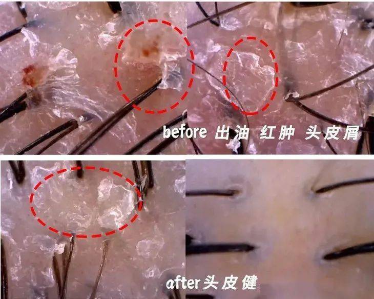 头皮头发总掉竟是「发根」缺了它！简单一招，5天生新发！发量重回18岁