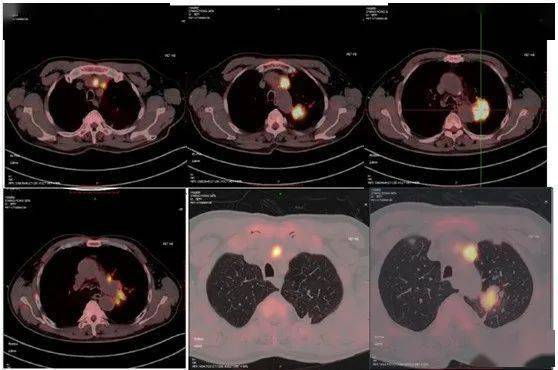 局部晚期肺鳞癌免疫治疗后的疗效评价 | 广东大会诊_病灶_肿瘤_复查