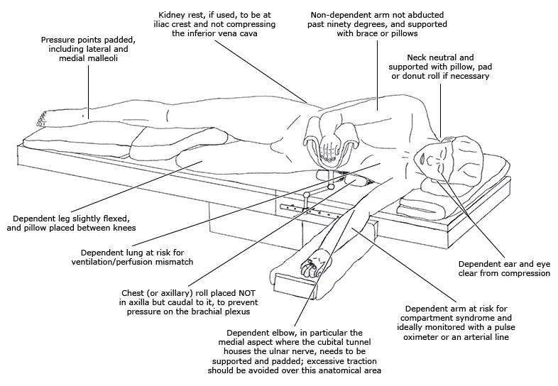麻醉医生应该关注的手术体位之反特伦德伦伯卧位及侧卧位