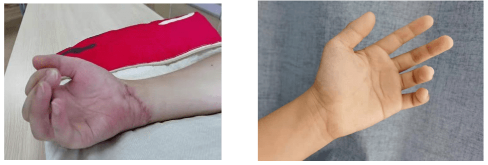 手功能基地系列微文23尺神经损伤术后康复