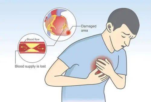 从"嗓子疼"到心肌死亡仅5天!速效救心丸和硝酸甘油,谁才是救命药?