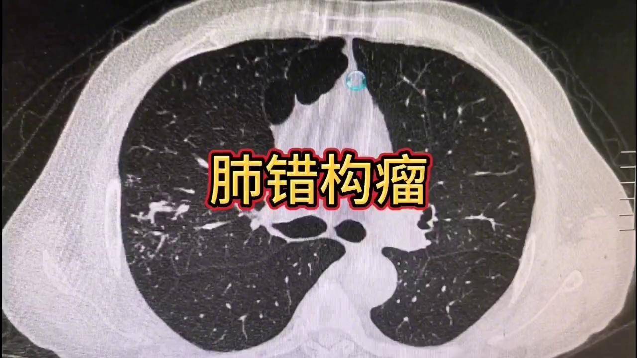 肺部错构瘤图片