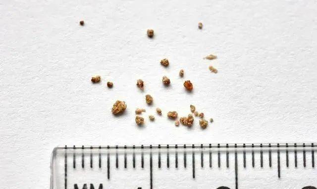 Vol|6岁男童双肾长满石头，罪魁祸首竟是妈妈！后悔死了…