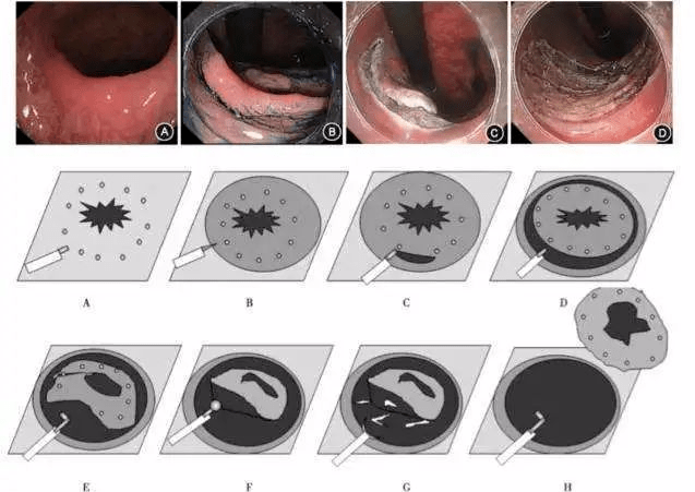 2,通電後利用熱能產生的熱量將息肉切除;3,觀察腸壁漿膜層有無損傷